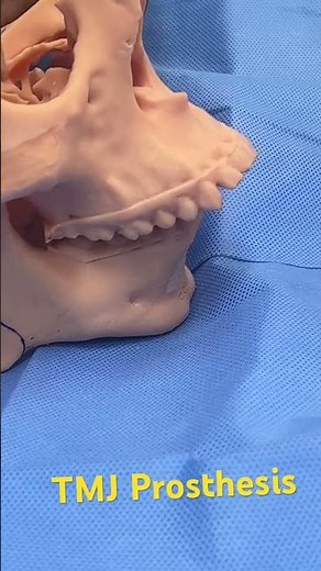 How Custom Patient Specific TMJ Prosthesis helps Patients