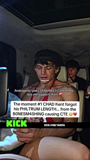 Kent's Philtrum Length Moment During B0NESM4SHING