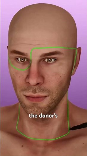 Face Transplant Surgery (3DAnimation)#facetransplantrecipient #plasticsurgery #plasticsurgeon
