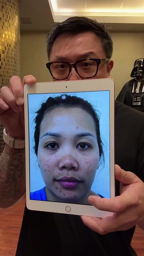 4 Weeks After Surgery: Amazing Results at The Icon Clinic