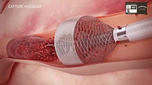 血栓是怎么被清除的快看这种先进的机械取栓系统