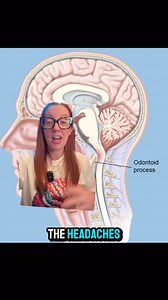 Betsy Grunch, MD | Neurosurgeon on Instagram: "Case Study 151 - Basilar invagination Basilar invagination occurs when the top of the second vertebrae moves upward. It can cause the opening in the skull where the spinal cord passes through to the brain (the foramen magnum) to close. It also may press on the lower brainstem. If there is pressure on the lower brainstem, its first symptom may be death. Otherwise symptoms vary depending on whether the spinal cord, brain stem, nerves or their blood su
