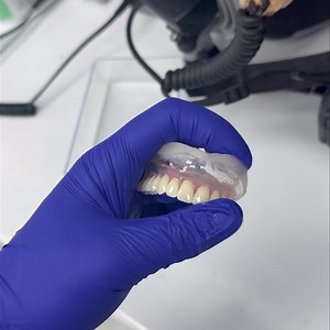 Acry-Free Soft Vacuum Dentures | Dr. Mikael D.Aslanyan, DMD, DDS