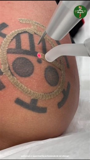 Why Tattoo Not Visible After Removal #shorts #ytshorts