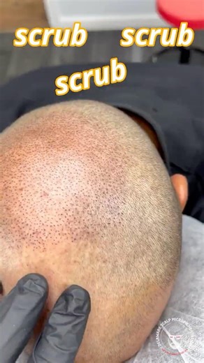 Full Scalp Micropigmentation Transformation | From Thinning Hair to a Permanent Shape-Up #smp