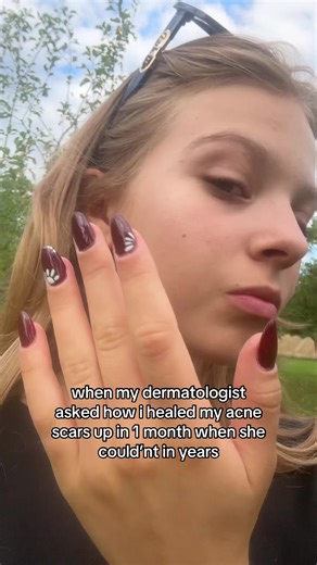 Skincare Routine to Heal Acne Scars in One Month