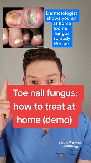 Home Remedy for Toe Nail Fungus Treatment