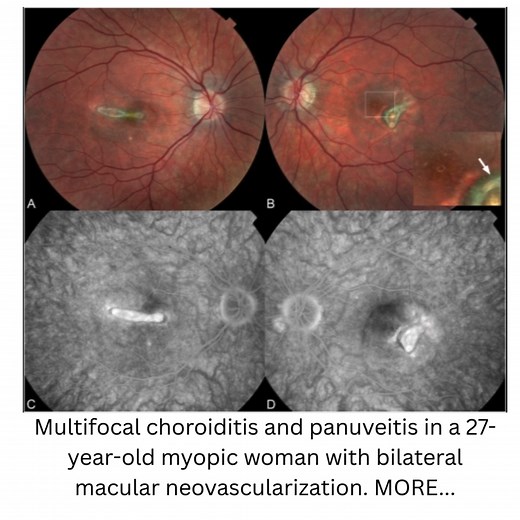 Retinal Cases & Brief Reports on Instagram: "SEVERE RECURRENCE AND RETINAL INFLAMMATORY INFILTRATION AFTER CESSATION OF IMMUNOSUPPRESSION FOR MULTIFOCAL CHOROIDITIS AND PANUVEITIS Ossewaarde-van Norel, Jeannette MD, PhD; Spaide, Richard F. MD Retinal Cases & Brief Reports 19(3):p 289-293, May 2025 A patient with multifocal choroiditis and panuveitis had a severe recurrence after a sudden cessation of immunosuppression because her diagnosis was changed to punctate inner choroidopathy. She present