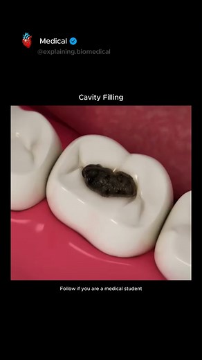 Medical on Instagram: "A cavity filling is a dental procedure to treat tooth decay. The dentist removes the decayed portion of the tooth and fills the space with materials like composite resin, amalgam, or ceramic. This restores the tooth’s structure, prevents further decay, and relieves sensitivity or pain caused by the cavity. . For educational purpose only. #viral #explore #reel #education #medical #doctor #medicalstudent #student #study #biology #mbbs #mbbsstudent"
