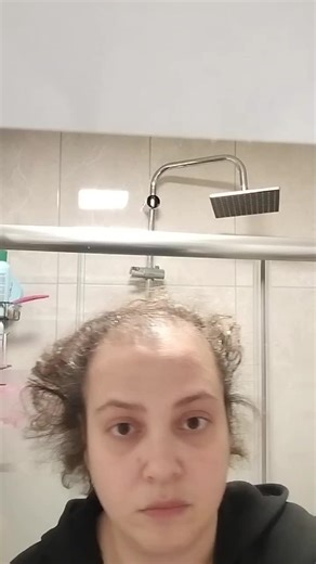 Saç Dökülmesini Durdurma Yöntemleri