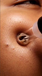 Blackhead Plug Out — Satisfying Shot