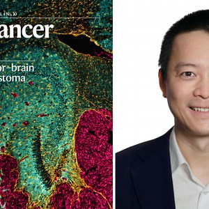 UofT Researchers Pave the Way for New Glioblastoma Treatment