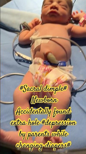#sacral dimple what it is ? #howto manage sacral dimple #newbornscreening #newborn #nicugraduate