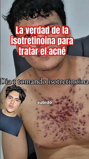 Does this guy have acne fulminans? #looksmaxxing #acne #glowuptips #dermatology #skincare