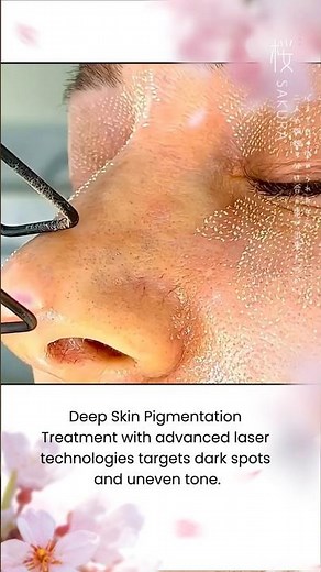 Advanced Laser for Skin Pigmentation: Facial Rejuvenation and Radiant Glow