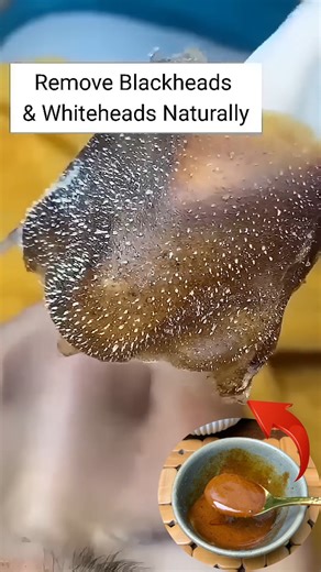 1.2M views · 4.6K reactions | Remove Blackheads & Whiteheads Naturally At Home . . . #blackheads #whiteheads #blackheadsremoval #whiteheadsremoval #skincare #reelsvideoシ #fbreelsfypシ゚ #reelsviralシ #fbreelsfypシ゚viralシ #reelschallenge #explorepage | Natural Beauty Recipes | Facebook