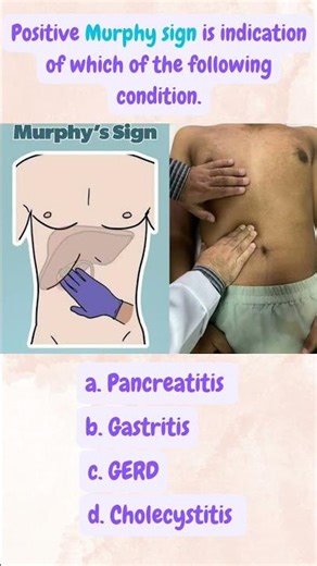 Murphy sign is a physical examination finding in cholecystitis