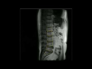 Automated vertebral tracking algorithms - HASTE ACTIVE