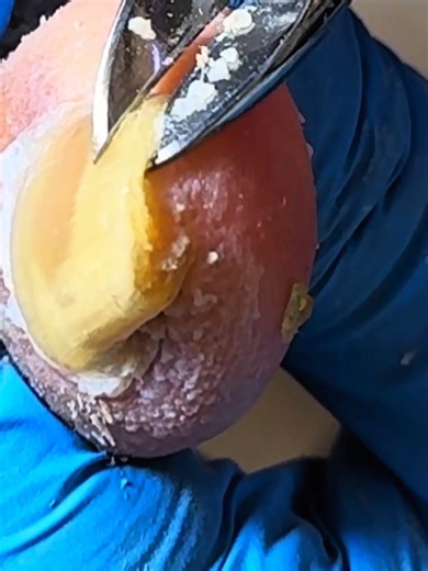 Very big toenail removal and pedicure process #longtoenails #thicktoenails #Ingrown #Pedicure #toenails #Toenailfungus #nail #cleannail #warts #cleaner #toenailremoval #ingrowntoenailremoval Disclaimer: Videos do not show original ingrown nails,they are used for education purpose. Thank You,,, | RoBi Bro's