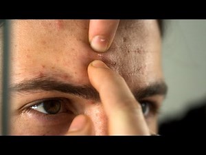 Pimple explodes in slow motion