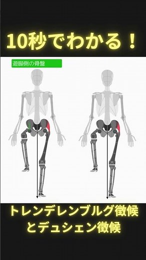 10秒でわかるトレンデレンブルグ徴候とデュシェンヌ徴候 #理学療法士 #理学療法士 #理学療法 #ptタイガー #柔道整復師 #足病学 #日本足病学協会 #podiatry #足部解剖
