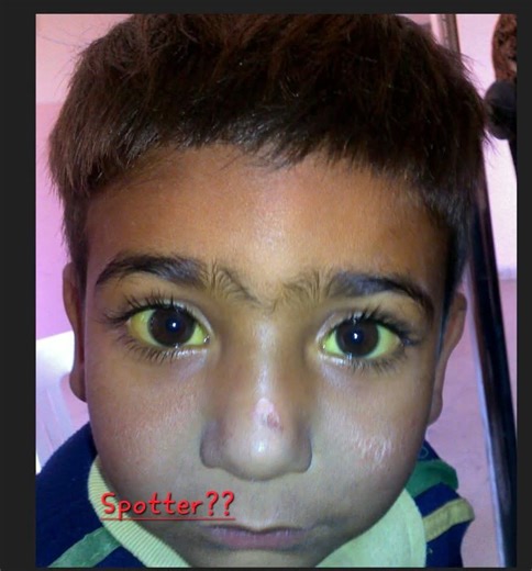 Dr.Naveed Ahmad Jalbani | The image shows a child with yellow discoloration of the eyes (scleral icterus) — a classic finding of jaundice. 🔍 Findings: Yellow... | Instagram