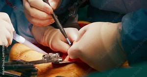 Close up of cancer surgery. Team of skilled surgeons remove cancer cells from stomach with modern laser technology,cut out tumor from patient body,working on open wound.Handheld documentary style shot
