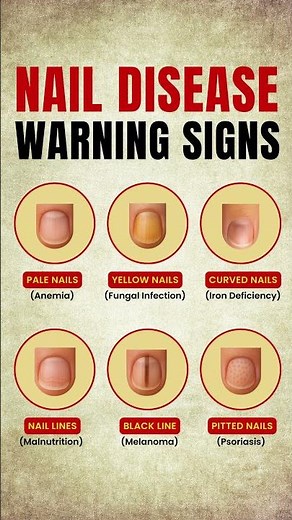 Nail Disease Warning Signs You Should Never Ignore | Nail Health Symptoms #healthlifestyle