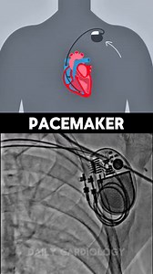 349K views · 2K reactions | Permanent Pacemaker in Action #reelschallenge #short #cardiology #hearthealth | Daily Cardiology | Facebook