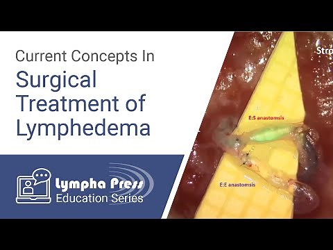 What Primary and Secondary Lymphedema Patients Should Know When Considering Surgery - Dr. Wei Chen