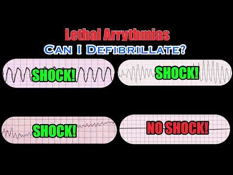 Lethal Arrythmias: Identification and Response