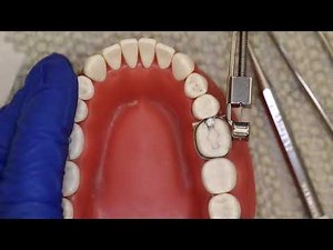 Pack And Condense Amalgam