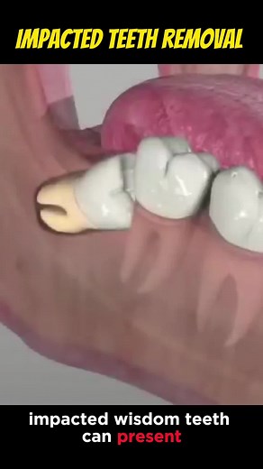 Impacted Tooth Removal: 3D Animation Procedure Explained