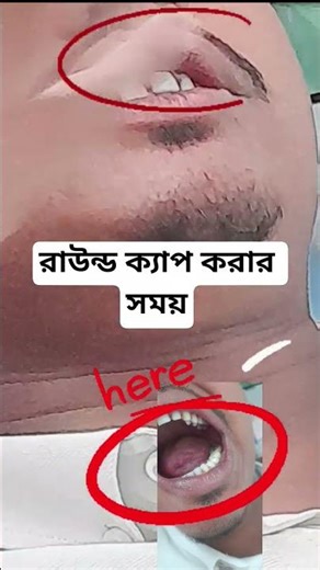 রাউন্ড ক্যাপ করার সময় #dentaltips #dentist