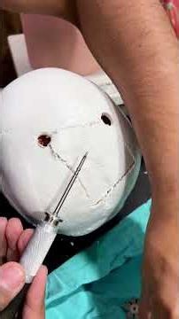 Watch How Neurosurgeons Close the Skull After Surgery: A Demo