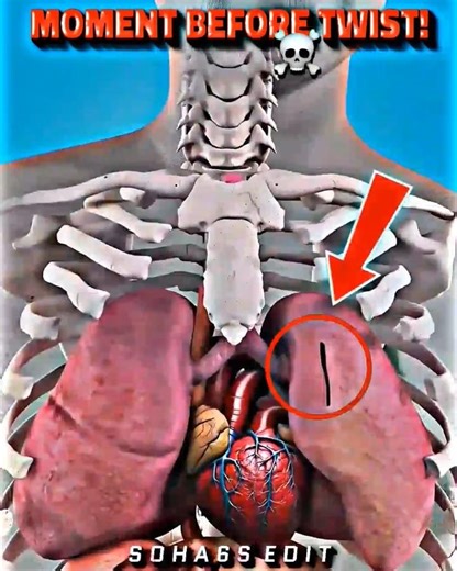 When a Lung Gets Punctured – Act Fast! #troll #trollface #trollfaceedit #edit