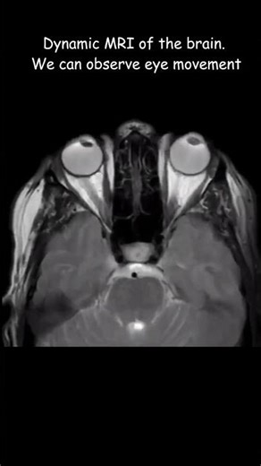 Real eye movement in MRI #eyes #eyemovement #medicaleducation