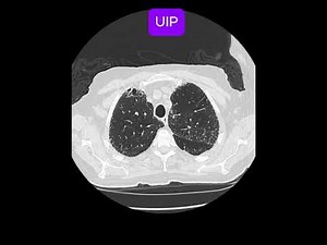 Usual interstitial pneumonia (UIP)