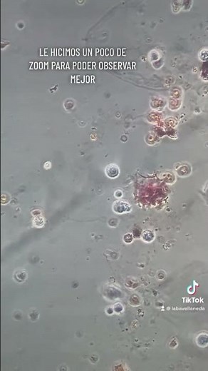 Leucocitos y eritrocitos en muestra de orina #labclinico🦠🔬 #ego #leucocitos #eritrocitos