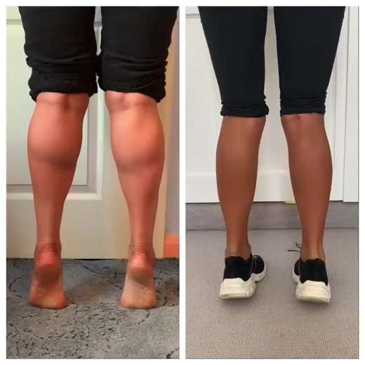 Effective Calf Reduction Techniques for a Sleeker Look