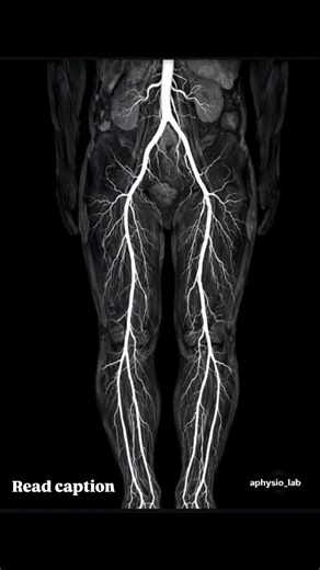 Physio on Instagram: "✨ MRA (Magnetic Resonance Angiogram)🧬 ✅ provides a clear visualization of arterial bifurcation and distribution: Aortic Bifurcation: At the L4 vertebral level, the abdominal aorta terminates by dividing into the Common Iliac Arteries. The Transition: Note the subsequent division of the common iliacs into the Internal Iliac (supplying pelvic viscera) and the External Iliac, which continues distally to become the Femoral artery. Femoral Artery: The primary lifeline of the lo