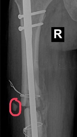 Femur Fracture Recovery || The Road To Recovery || Tibia Fibula Femur &Other Fracture's Recovery ||