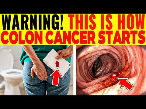 10 first signs of colon cancer that you should never ignore | 586