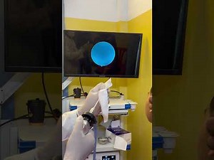 Professional Earwax Suction 😳 | Deep Ear Cleaning Results #entclinic #viralvideo #health