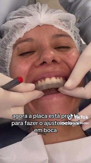 Faca você mesmo: Placa oclusal, parte 2. #AmelhorDVO #estabilidadedentaria #placaoclusal