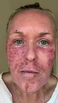 Fully Ablative CO₂ Laser Recovery | Donna’s Healing Journey (Day 0–18)