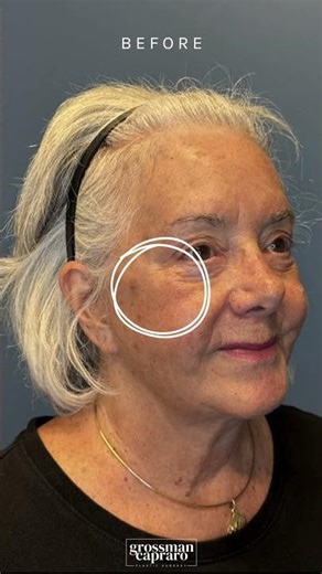 The Post-Renuva Glow | Natural Before and After