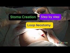 Stoma Formation | Surgical Principles of Ileostomy - By Surgiplex Team