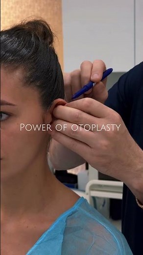 Power of OTOPLASTY - Cosmetic ear surgery for shape improvement [Doctor Levy Romania - Bucharest]