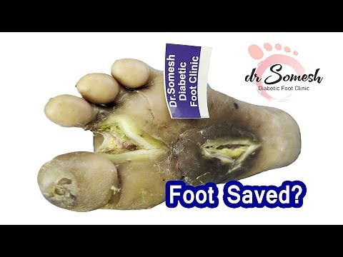 Gangrene Foot Amputation ? Before After Video #diabeticfoot #diabeticinfection